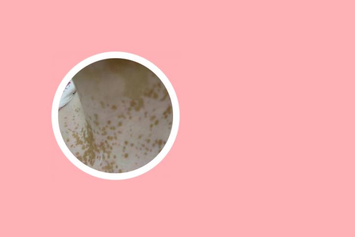 白癜风会引起高血压吗