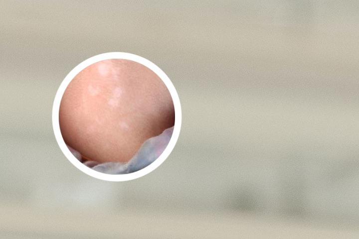白癜风王医生推荐洗发水