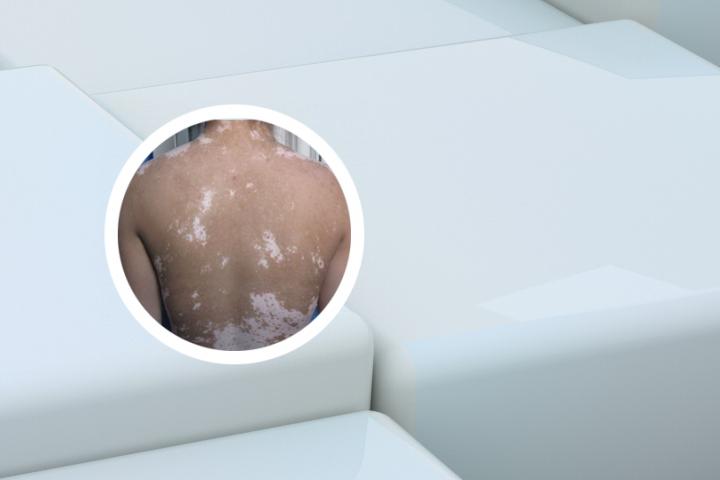 蝎子酒治疗白癜风