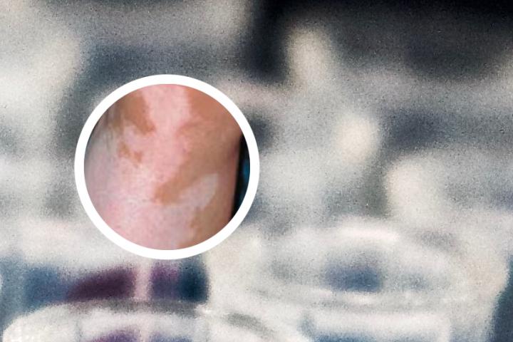 白癜风属于癫痫吗