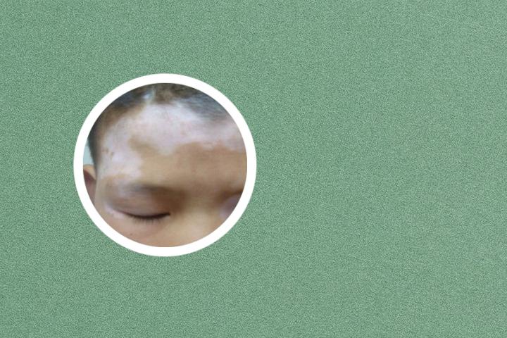 白癜风微针导入 白癜风微红是好现象吗