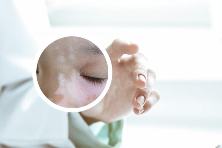 昆明治疗白癜风哪最好