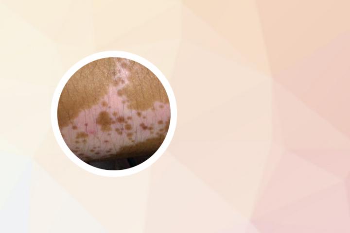 白癜风患者吃哪些菜