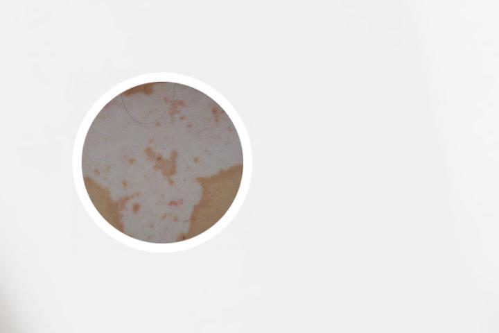 得了白癜风可以吃白萝卜吗