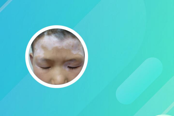 白癜风里面有小黑点