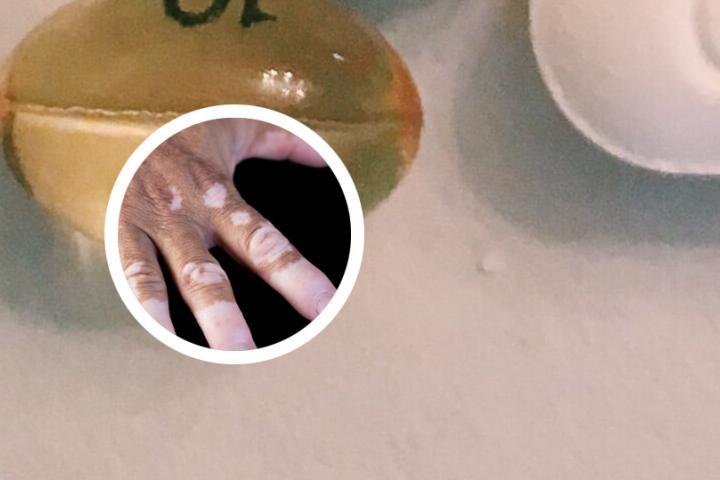白癜风营口哪里治的好
