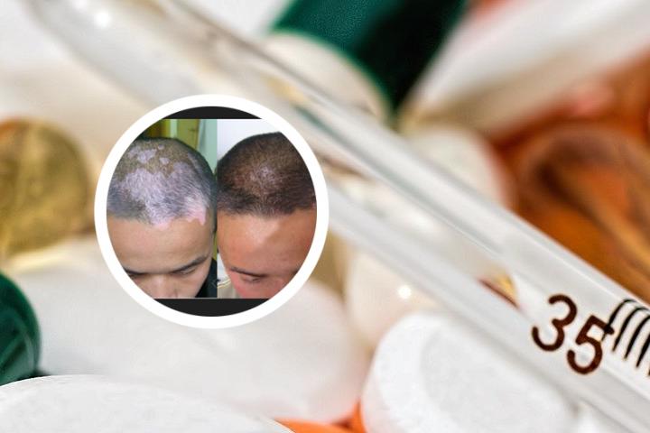 进展期白癜风黑色素培植