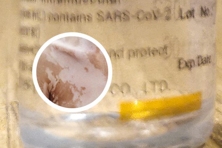 白癜风患者禁止吃的肉类