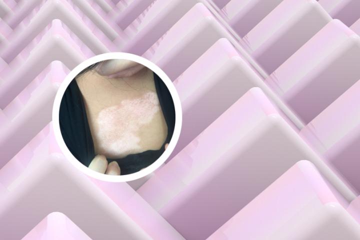 白癜风有什么造成