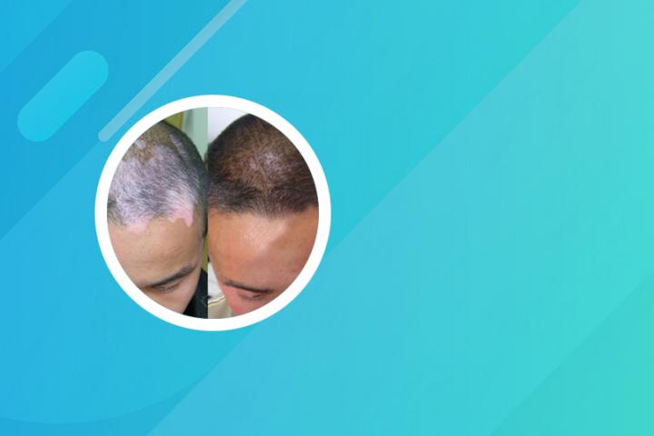 白癜风与白斑一样吗
