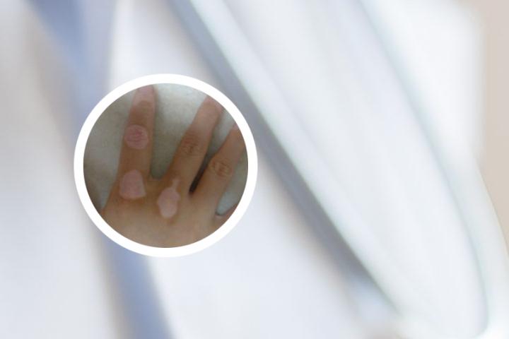 白癜风晚上能吃鸡蛋吗