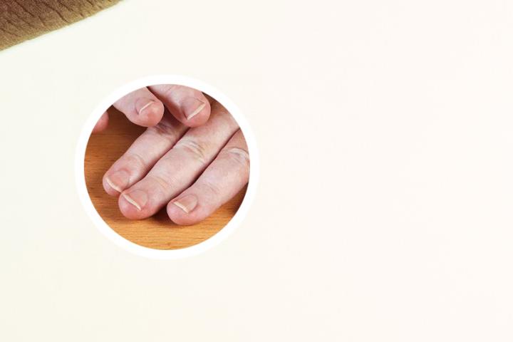 白眉就是白癜风吗