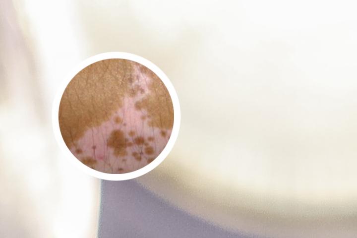 白癜风为何要注意防晒