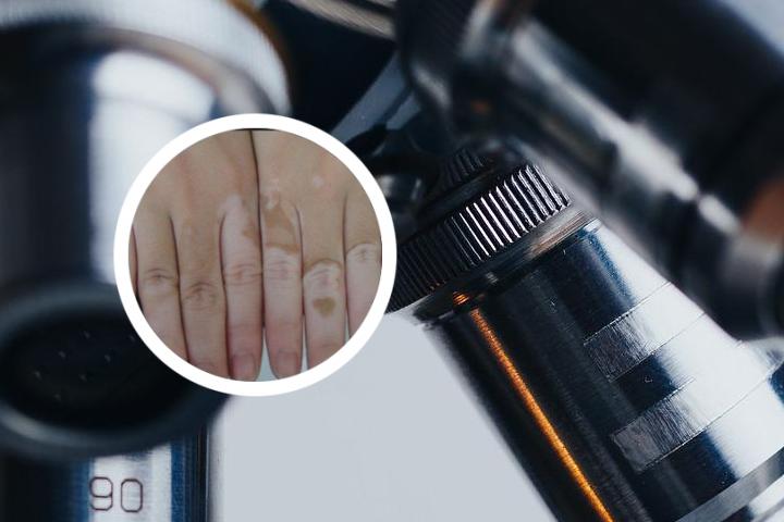 得了白癜风娶不到老婆了吗