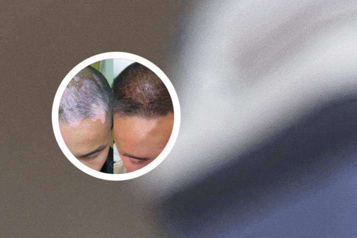 郑州治白癜风的专科医