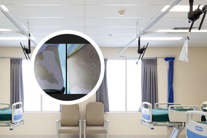 白癜风危害健康 白癜风危害身体健康吗