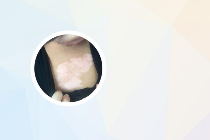 白癜风维生素b2 白癜风维生素e