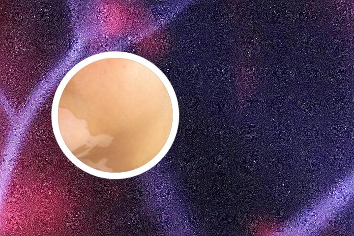 中医治疗白癜风有治愈了吗