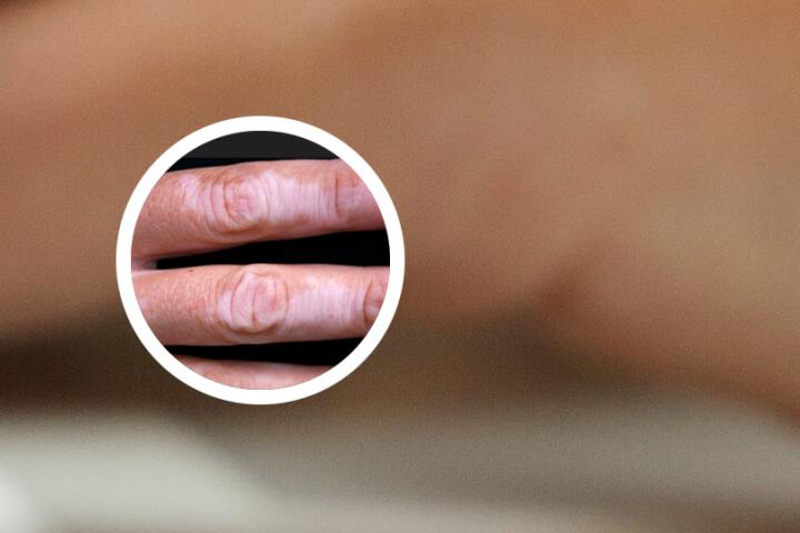 白癜风可以通过唾液传染吗
