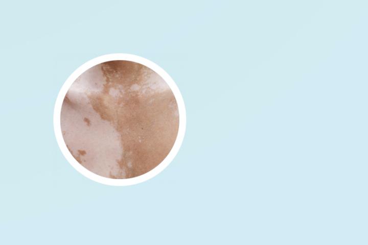 白癜风患者能吃柠檬么