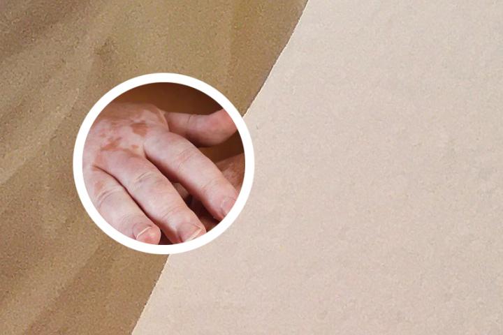 白癜风由初发地方扩散吗