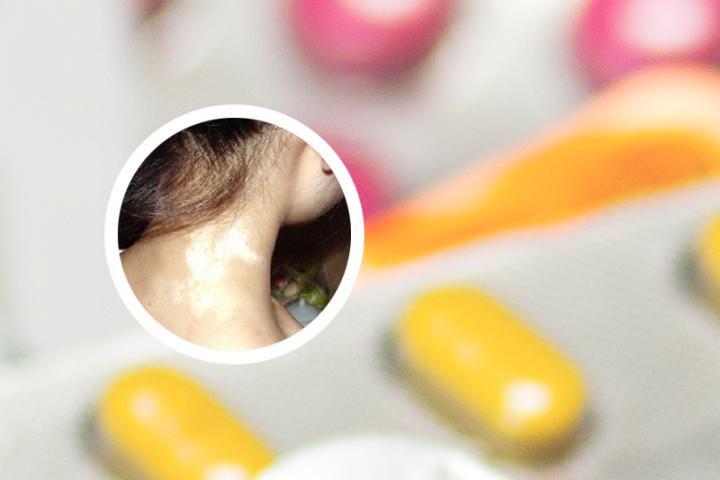 成都博润白癜风医院怎样