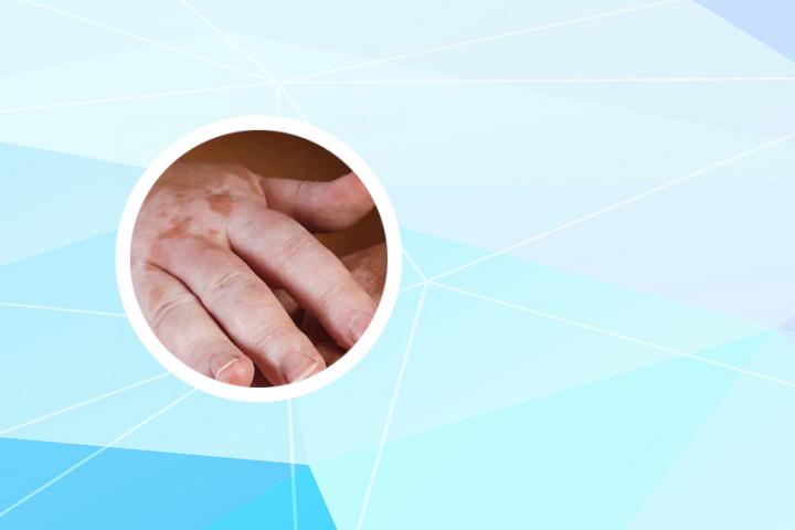 白癜风为什么长时间不愈