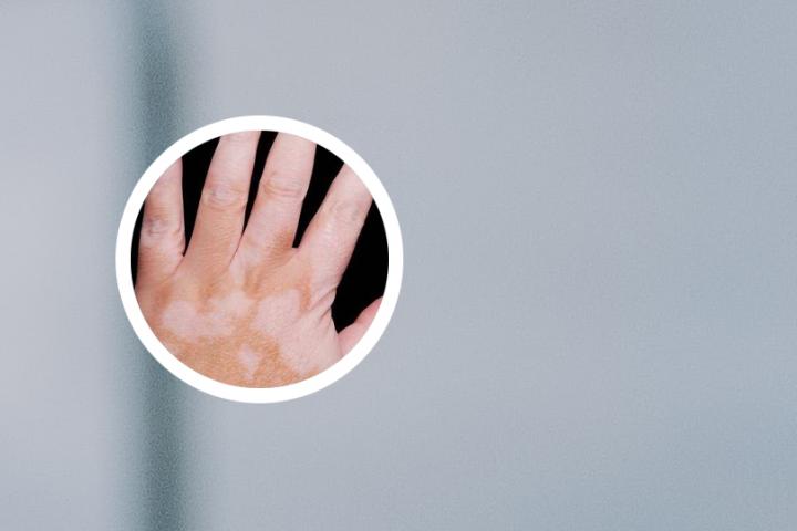 眼皮上长了白癜风怎么治疗