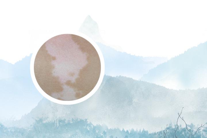 白癜风微量元素缺乏学说 白癜风微量元素缺什么