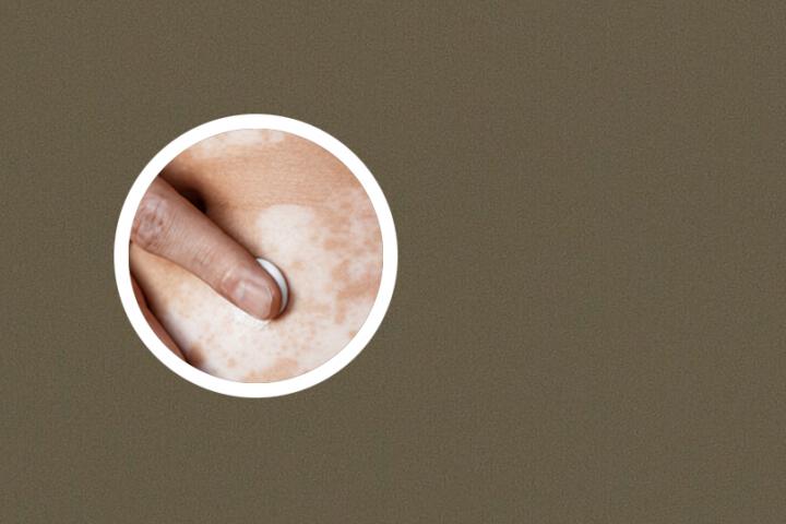 白癜风的脖子特点