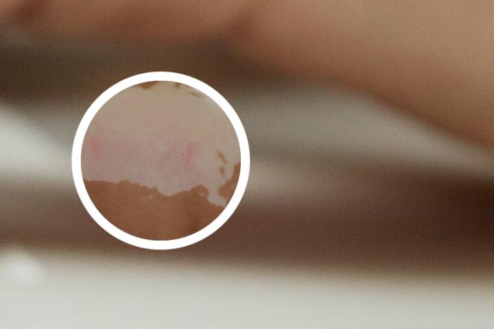 白癜风遮暇还能光疗吗