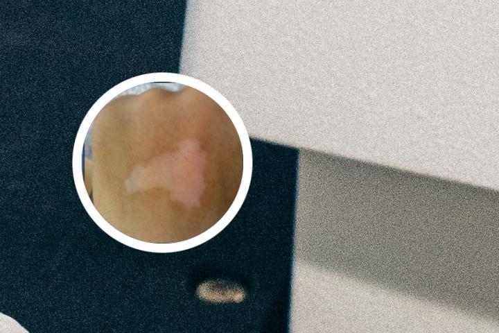 长沙治白癜风蓶中研解答