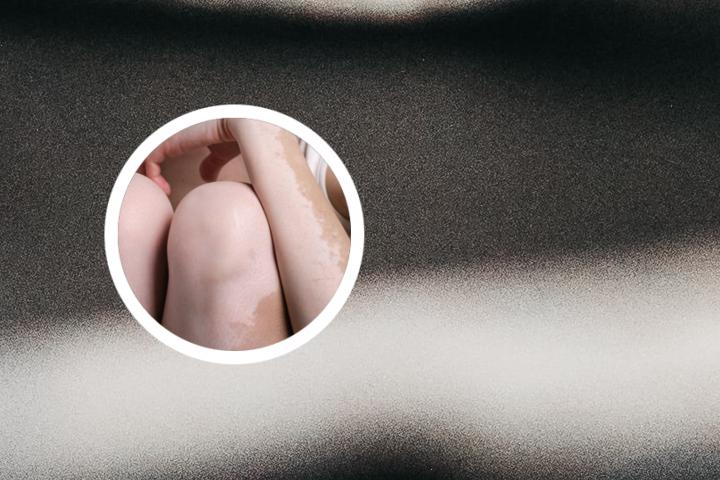 白癜风维生素c能吃吗