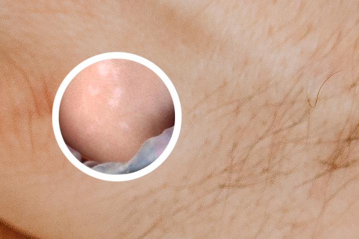 白癜风费用刘淑芸答疑