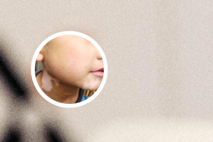 武汉儿童白癜风挂什么科
