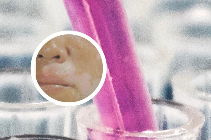 白癜风胶囊效果咋样