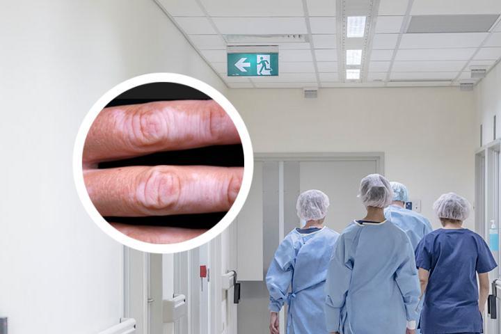白癜风睫毛眉毛