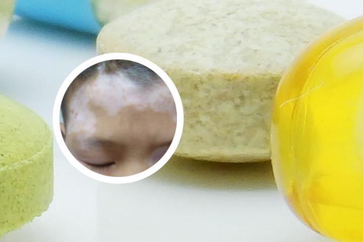 脚上有白癜风用治吗