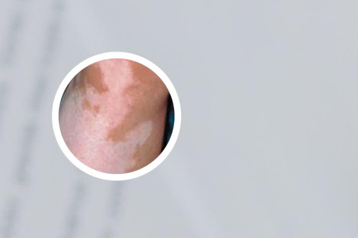 男人得白癜风遗传