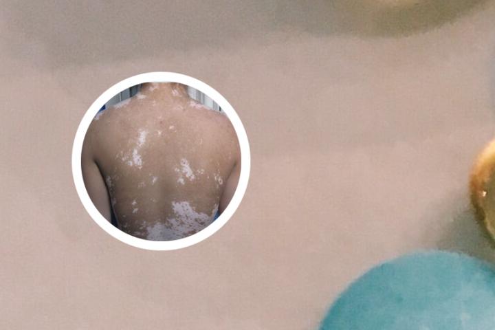 没有伤口怎么得了白癜风
