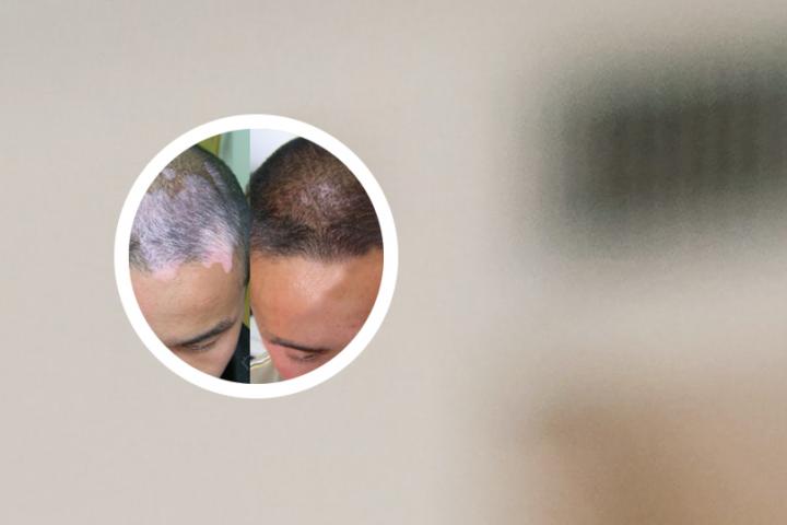 白癜风扩散的可能性有多大