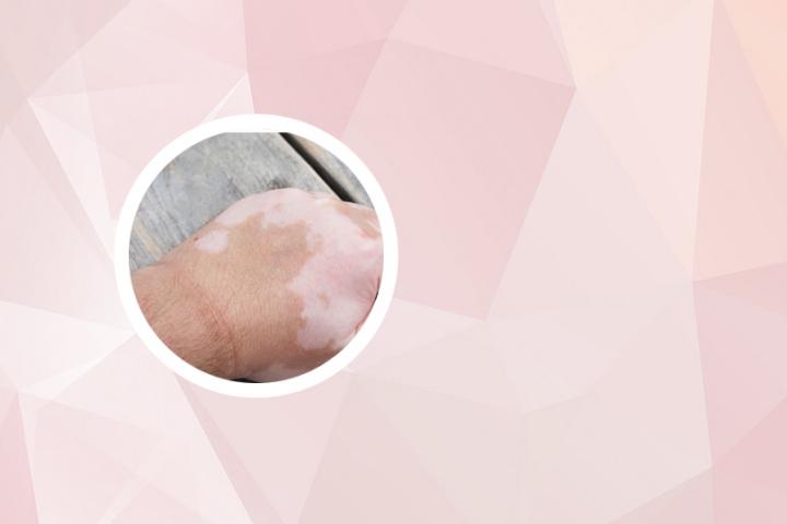 白癜风照完光结痂变黑