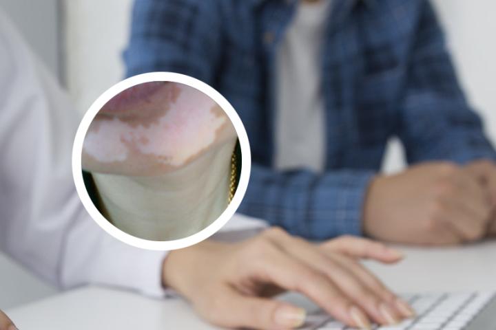升阳益胃汤能治疗白癜风吗