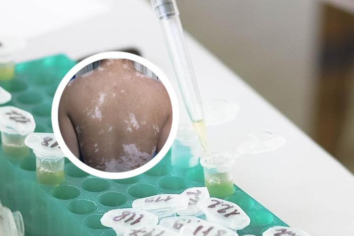 白癜风黑色素抑制