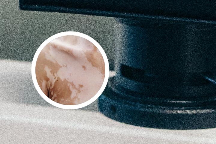 白癜风是由细菌导致的吗