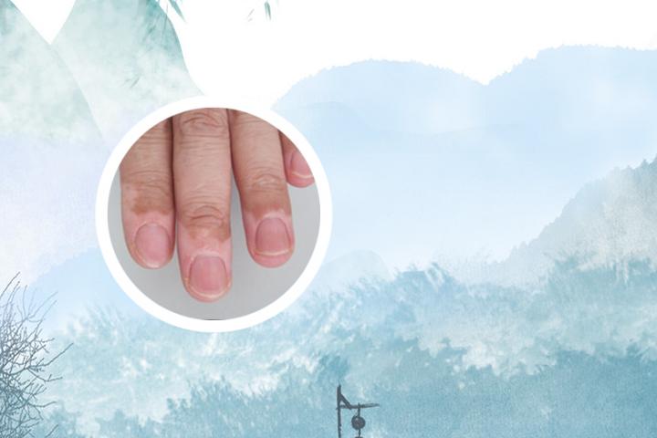 得白癜风该怎样治好
