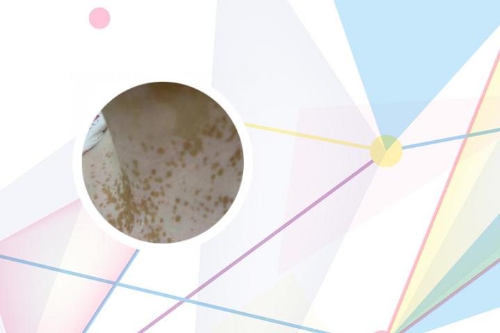 白癜风斑块按压变色吗