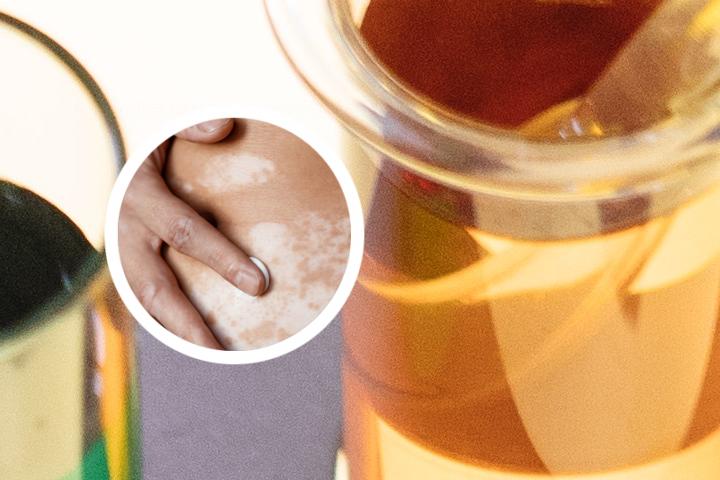白癜风网络咨询培训资料
