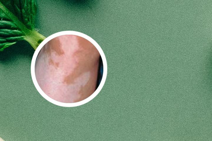 白癜风没有治疗自行好了