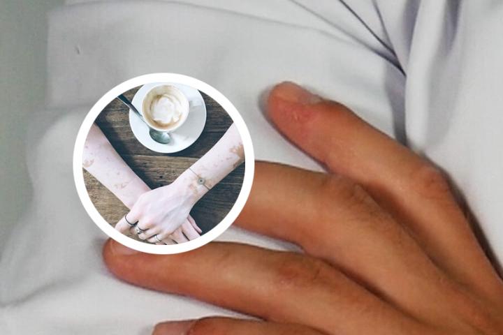白癜风怎么化妆才不显眼